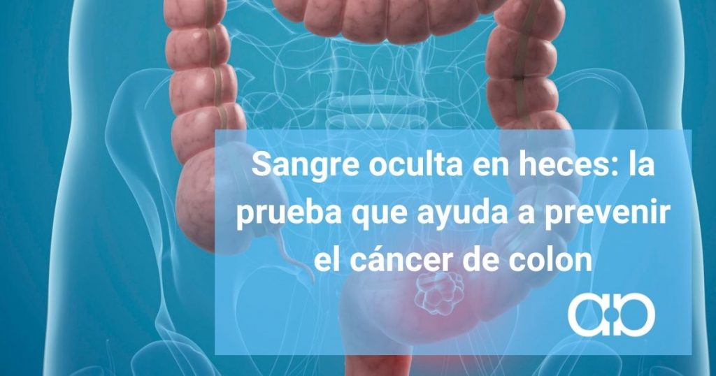 Sangre oculta en heces: la prueba que ayuda a prevenir el cáncer de colon